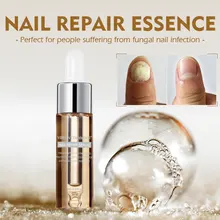 1 шт., средство для ухода за грибок ногтей, эссенция для ногтей, удаление грибка для ногтей, гель, анти-infecective Paronychia, лечение грибков для ногтей