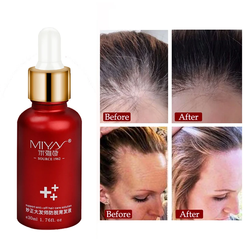 Hair Growth Essence Oil Anti Hair Loss Products for Hair Growth Treatment Genger Natural Serum Hair Thickener Care Solutions