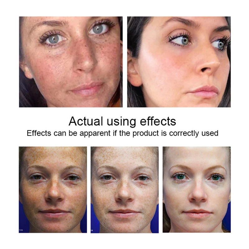 snmlpm freckle cream