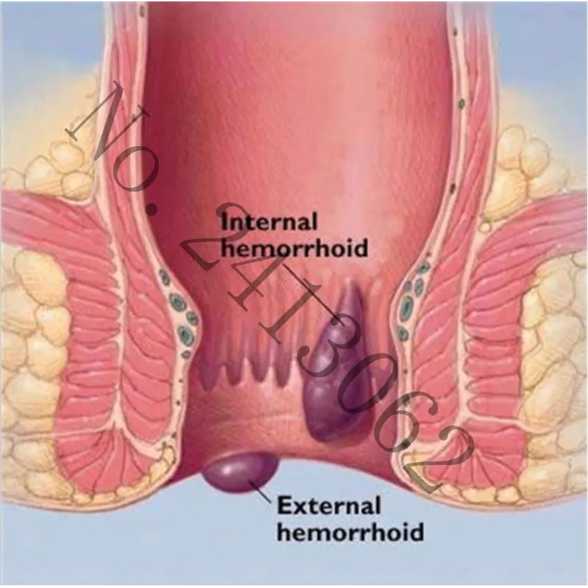 15 г крем от геморроя травяной экстракт мазь эффективное лечение анального