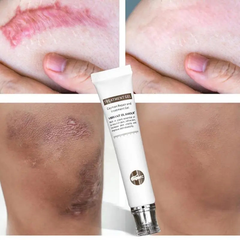 

VIBRANT GLAMOUR Repair Scar Cream Removal Scars for Face or Body Pigmentation Corrector Scalded Surgery Scar Insect Skin Care