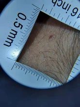 Lupa con mango de dermatoscopio 10X, visión clara suave con escala de medida, 30X, tipo B, visión más grande con luz UV