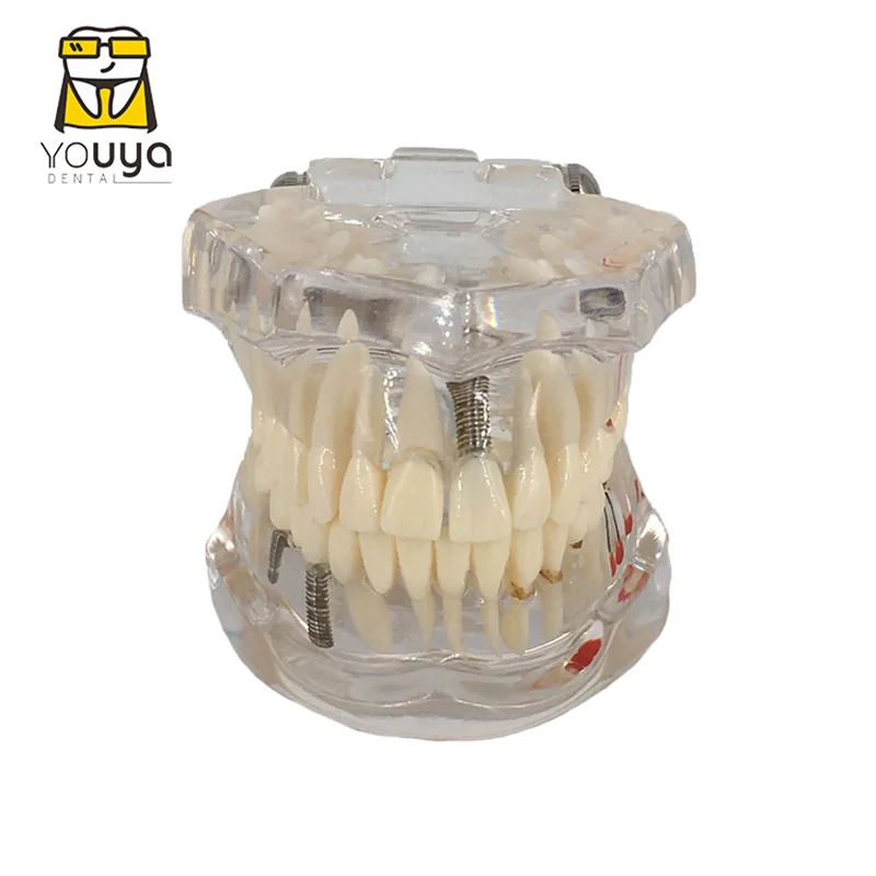 Transparent Disease Teeth Model Dental Implant Teeth Model Dentist Dental Student Learning, Teaching, Research Communication