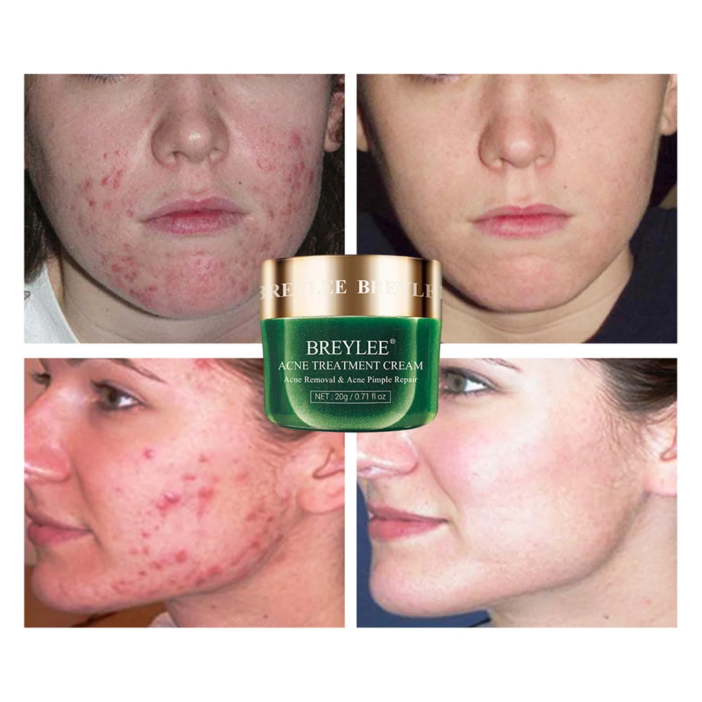 BREYLEE Acne Treatment Cream 20g Facial Essence Acne Scar Pimple Remover Acne Treatment Face Serum Mask Moisturizing Skin Care