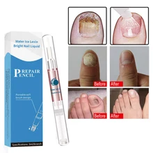 Эффективное удаление грибка стерилизация онихомикоз удаление сыворотки восстанавливающая жидкость для ногтей ручка