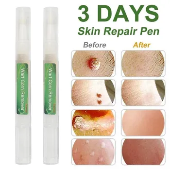 Wart Corn Remover Pen Clean Genital Warts Moles Papillomas Treatment Medical Skin Tags Plaster Removal Liquid Skin Health Care 1