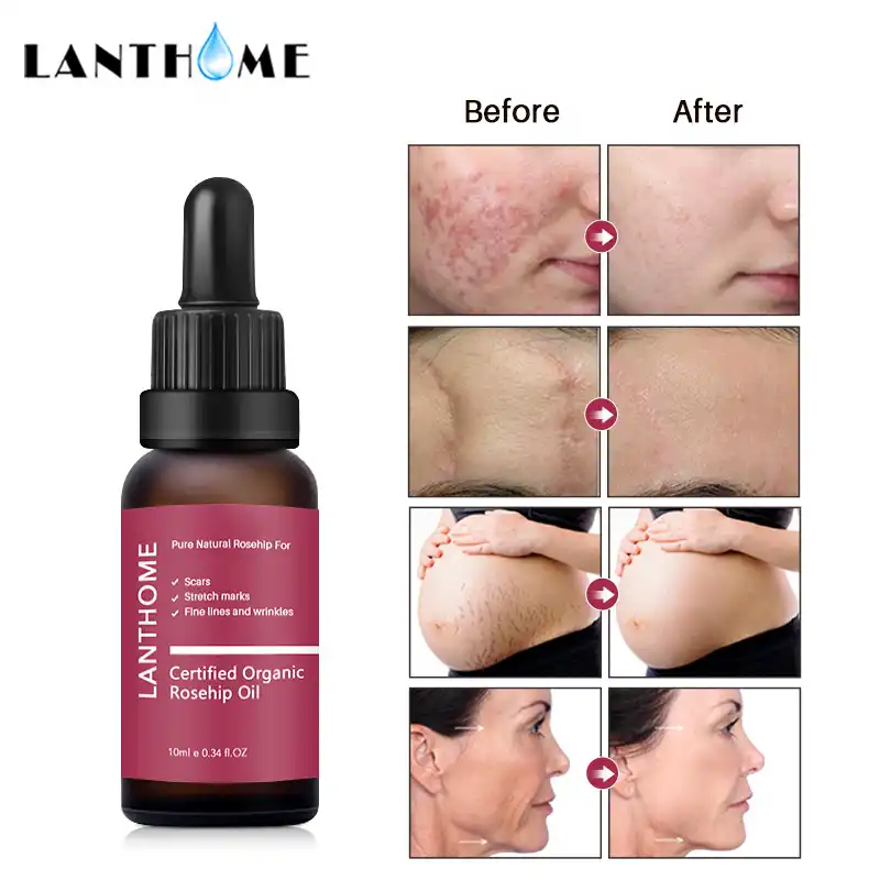 serum untuk acne scar