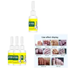 Горячая 15 мл лечение грибков ногтей Удаление онихомикоза против грибка Уход за ногтями восстанавливающая жидкость CUN 668