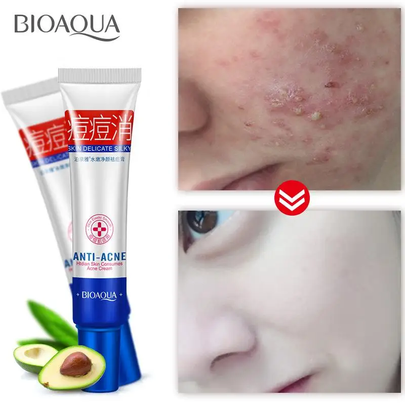 30g BIOAQUA Acne Cream Moisturizing Oil Control Fade Marks Mild Non-irritating Face Care Skin |