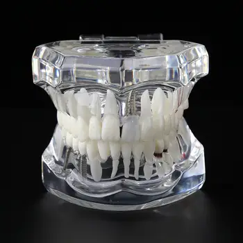 

Dental Implant Disease Teeth Model for Medical Teaching Oral Health Care