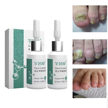 

10ml*2 Kills Bacteria Nail Care Treatment Nail Fungus Oil Onychomycosis Paronychia Anti Fungal Nail Infection Repair D110