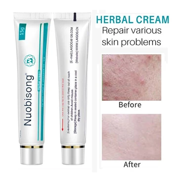 

Nuobisong face skin care treatment face Pimples scar Stretch Marks removal acne treatment whitening Pigmentation Corrector cream