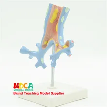 Бронхиальная патологическая модель дыхательный патологический бронхит демонстрационная анатомическая модель обучения медицине Mhxxt002