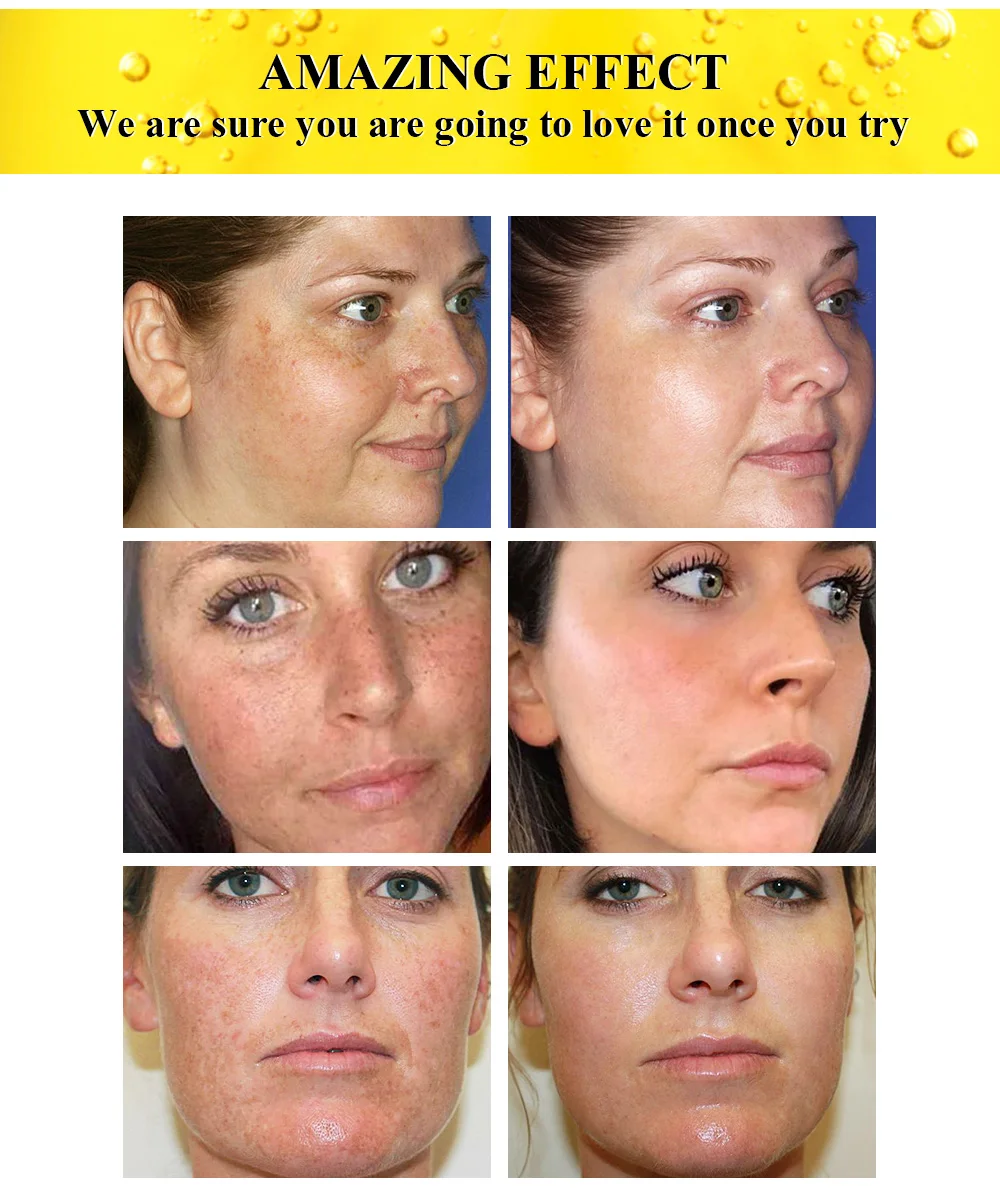 2 шт OMY LADY Acne Treatment Сыворотка для лица + удаление веснушек крем удаления пятен