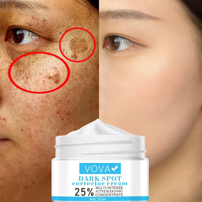 VOVA Dark Spot Remover Freckle Cream Remove Melasma Acne Spot Pigment Melanin Bleaching Dark Spots Pigmentation Whiten Skin Care