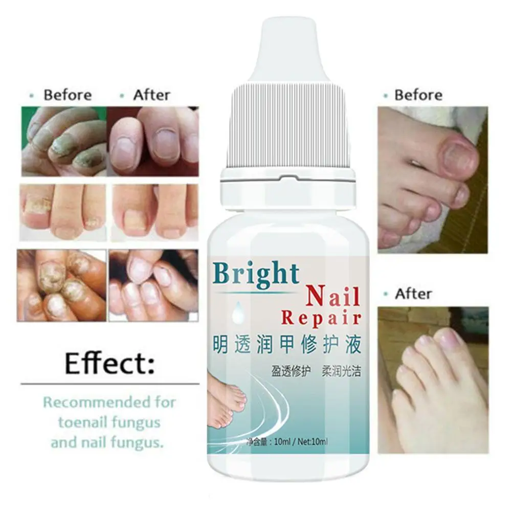 10ml Anti-fungal Cuticle Oil Nail Repair Treatment Growth Fungi Strengthen Nai Toenail Mint Manicure Fungus Bright B7C9 | Красота и