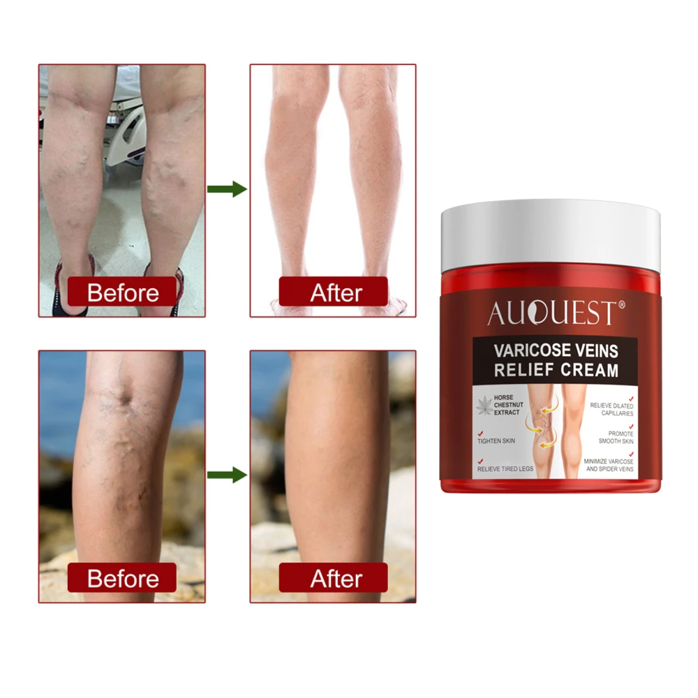 Varicose Veins Relief Cream Body Leg Vasculitis Phlebitis Spider Pain