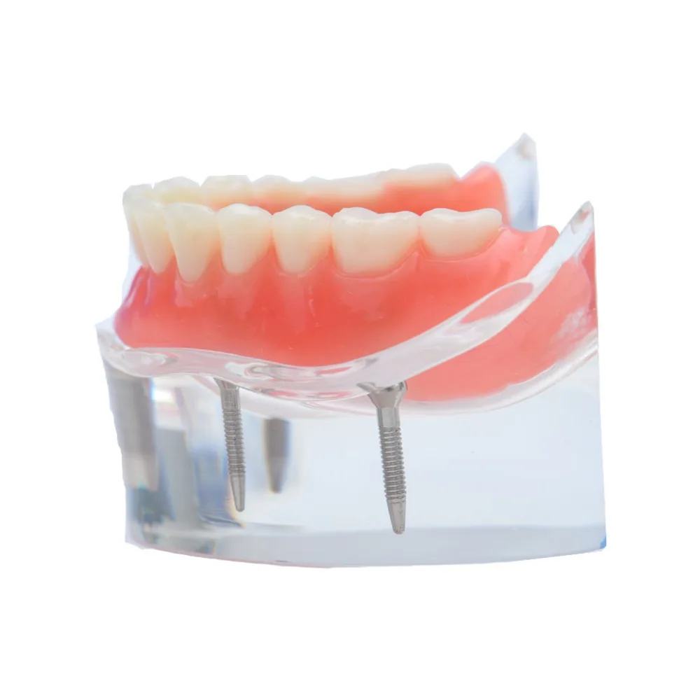 1 шт., зубной имплантат, модель зубов, восстановление протезов, прозрачный 6001, верхний 6003, нижний 6002, нижний имплантатный/нижнечелюстный
