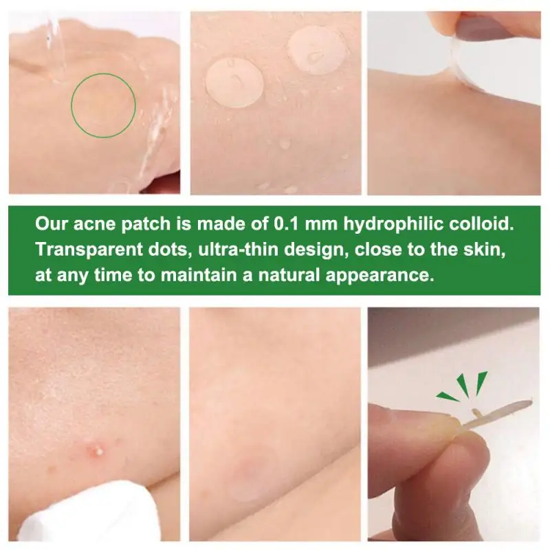 Invisible Acne Verwijdering Puistje Patch Absorberen Acne Afscheidingen Acne Freckle Patches Snelle Genezing Geschikt Voor TSLM1