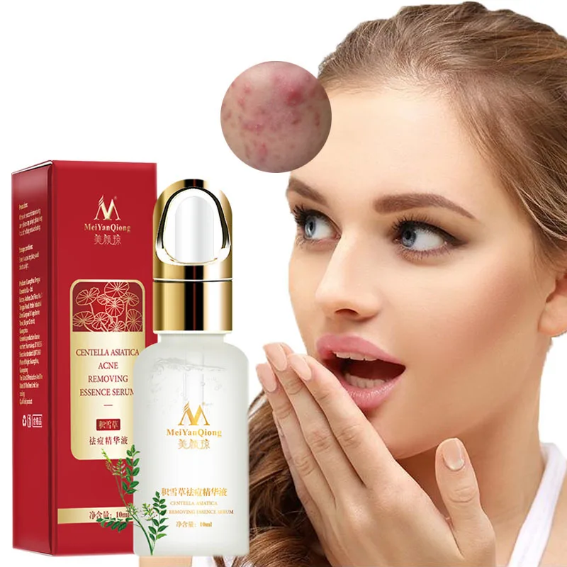 Acne Treatment Face Serum Centella Asiatica Oil Control Shrink Pores Scar Essence Whitening Moisturizer Skin Care | Красота и