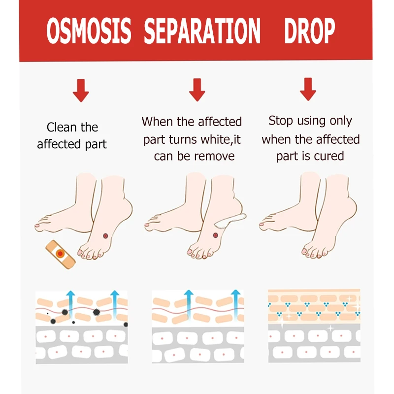 6pcs Foot Care Medical Plaster Foot Corn Removal Calluses Plantar Warts Thorn Plaster Health Care Pain Relief Pads Patches H044