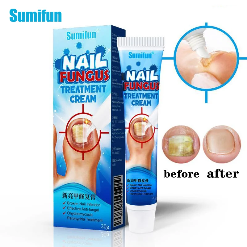 Мазь Sumifun для ухода за ногтями необходимая мазь лечения онихомикоза грибка