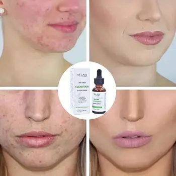 

30ml Tree Acne Repair Face serum Scar Acne Treatment Oil control Face Skin Care