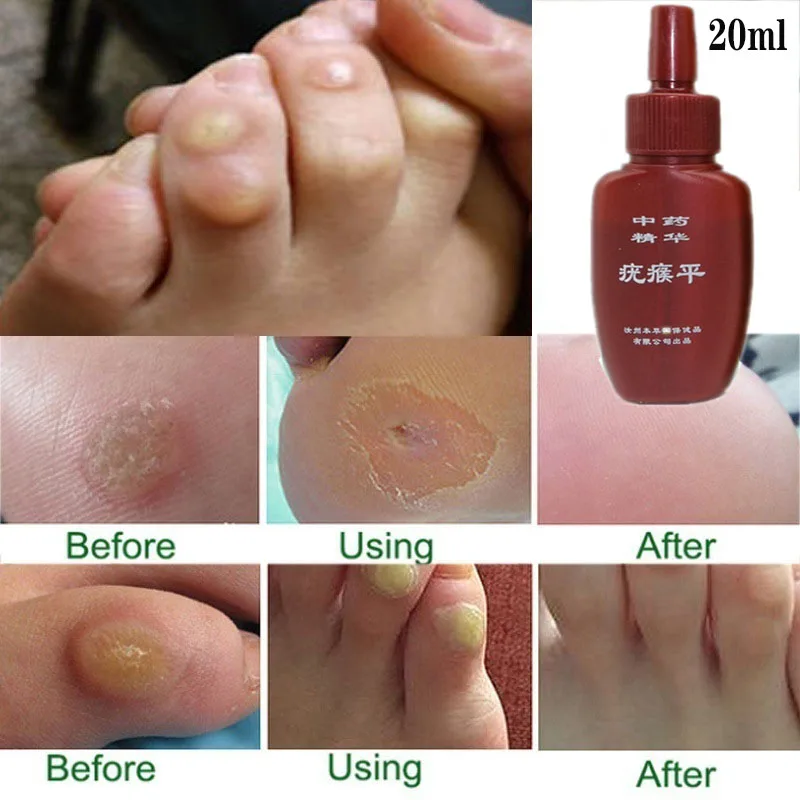 Share more than 143 nail polish remover for warts best noithatsi.vn