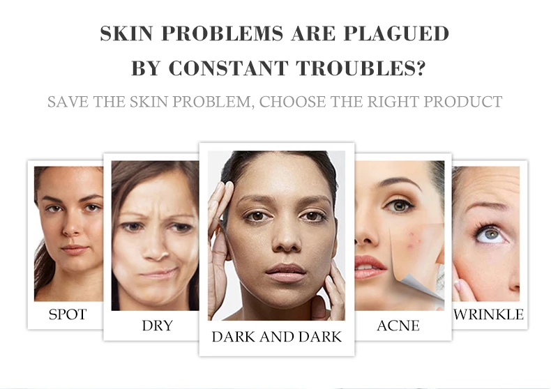 Aichun Whitening Freckle Cream Remove Melasma Acne Spot Lighten Dark Spots Pigment Melanin Hydration Moisturizing Face Care 30ml