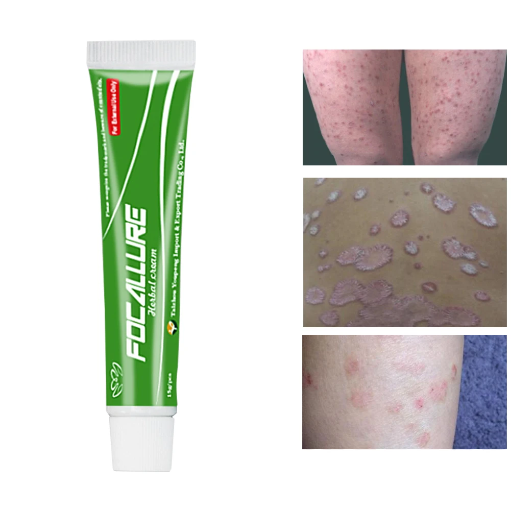 

Anti Bacteria Psoriasis Cream Pruritus Skin Problem Dermatitis Repair Eczema Ointment Easy Apply Body Ultra Strength Herbal