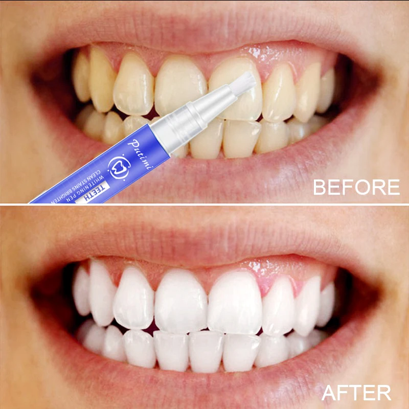 Oral Teeth Whitening Pen Remove Plaque Stains Whitening Pen Oral Hygiene Dental Tools Cleaning Bleaching Teeth 1 Oral Teeth Whitening Pen Remove Plaque Stains Whitening Pen Oral Hygiene Dental Tools Cleaning Bleaching Teeth 5