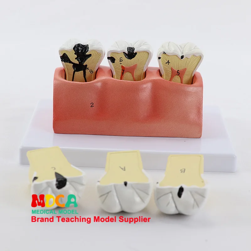 

Caries. Tooth Decomposition Model Teeth Oral Dental Display for Medical Teaching Model Myc008