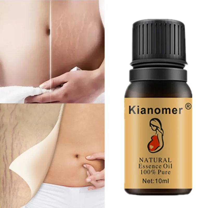 skin bleaching stretch marks