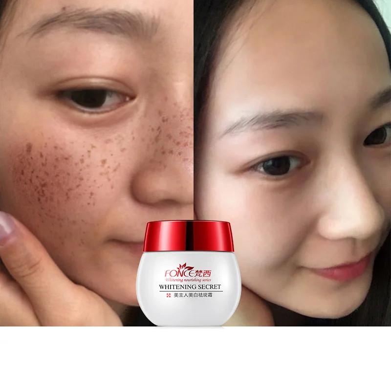 cream for freckles on face