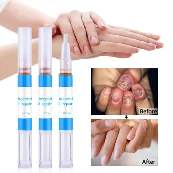

3pcs Leuconychia Repair Pen Nail Fungus Removing Pen Leuconychia Repair Liquid Leuconychia Removing Pen Nail Repair Liquid for G