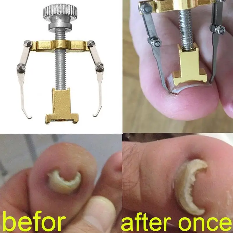 Ingrown Toenail Correction Tool Set Ingrown Toe Nail Clip Foot Straightening Care Brace Elastic Pedicure Patch Corrector Bu P4N7