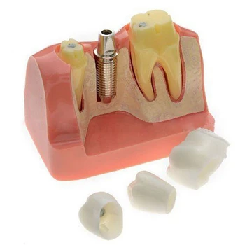 

Professional Teeth Model Transparent Pathological Implant Nerve Model for Science Disease Teaching Study