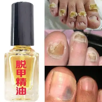 

3 Days Effect Fungus Removal Liquid Fungal Nail Treatment Repair Caring Nail Bright Foot Infection Anti Onychomycosis Y0P0