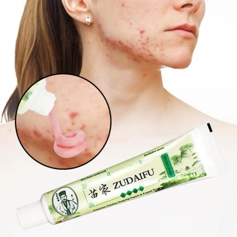 ZUDAIFU кожу крем от псориаза травяной крем от псориаза Антибактериальный Dermatiti Eczematoid по уходу за кожей