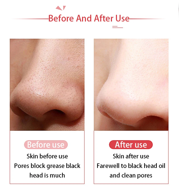 Ultrasonic Face Skin Cleaning Remover Blackhead Acne Pore Cleaning Exfoliating Facial Lifting Facial Scrubber Shovel Clean