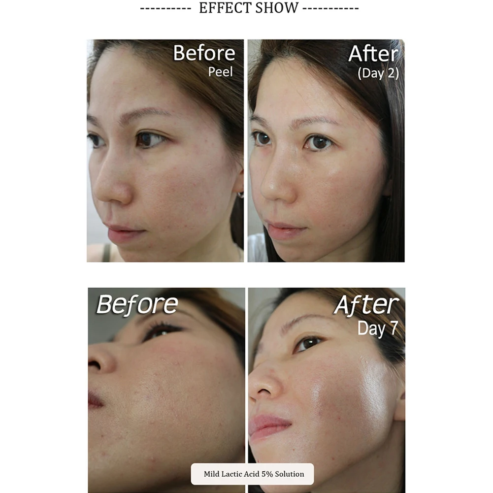 the ordinary lactic acid acne
