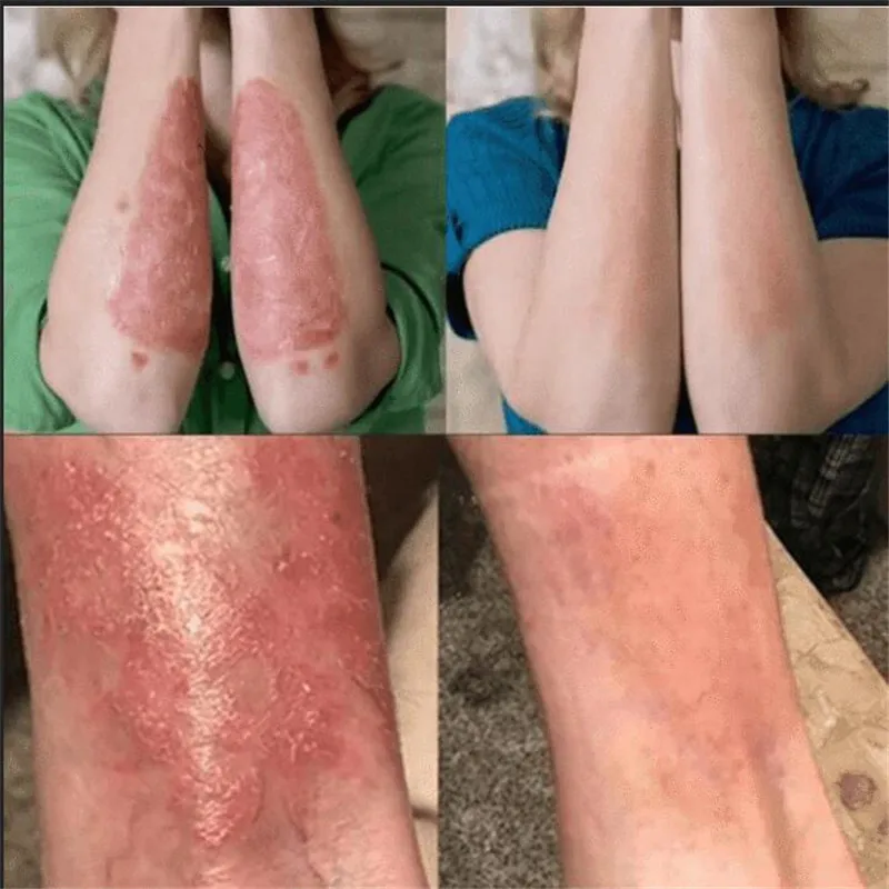 Решения для кожи крем для лечения псориаза крем дерматит Eczematoid экзема мазь для лечения псориаза крем по уходу за кожей крем