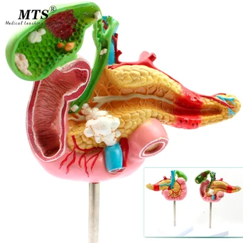 

Pancreatic Duodenal Gallbladder Pathological Model Gallstone Surgery Digestive System Model Medical Science