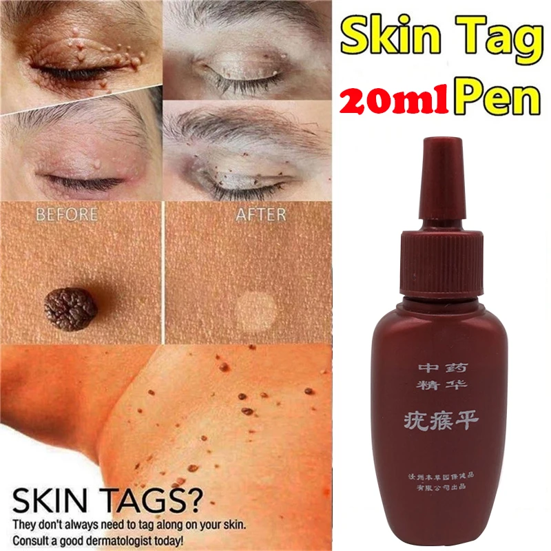 20ml Skin Tag Remover 12 hours Medical kill Remover Skin Tag Mole & Genital Wart Remover Foot Corn Removal
20ml Skin Tag Remover 12 hours Medical kill Remover Skin Tag Mole & Genital Wart Remover Foot Corn Removal