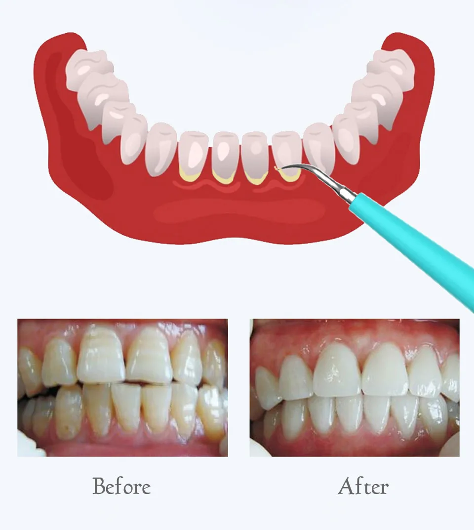 Новое обновление зубы Красители удаление зубного камня инструмент дым пятен средства для удаления зубного камня отбеливание зубов Очищающая машина зарядка через usb светодиодный светильник