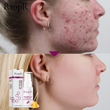 

Serum Propolis Repair Acne Brightening Acne Scar Spots Cleaning Shrink Pores Eliminates Acne Treatment Oil control Hyaluronic