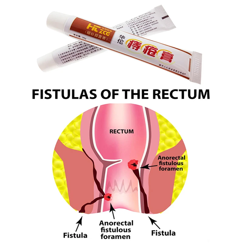 Hemorrhoids Ointment 100% Original Hemorrhoids Cream Internal Hemorrhoids Piles External Anal Fissure Medical Plaster S001