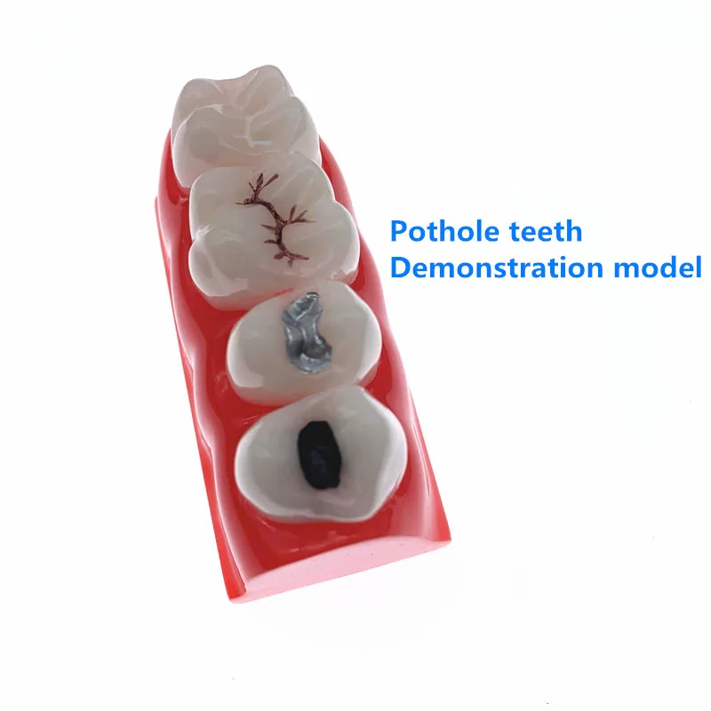 

Teeth Model Dental pit and fissure closed model Treatment Teeth Model Used for dental teaching research models