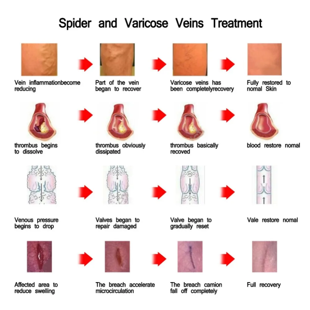 Китайская натуральная косметика фитотерапии для лечения варикозного сосудов, массаж, крем, лечение варикозные вены мазь