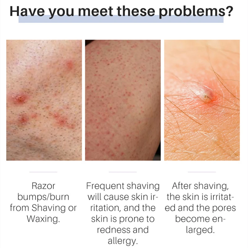 After Shave Pimples Treatment edu.svet.gob.gt